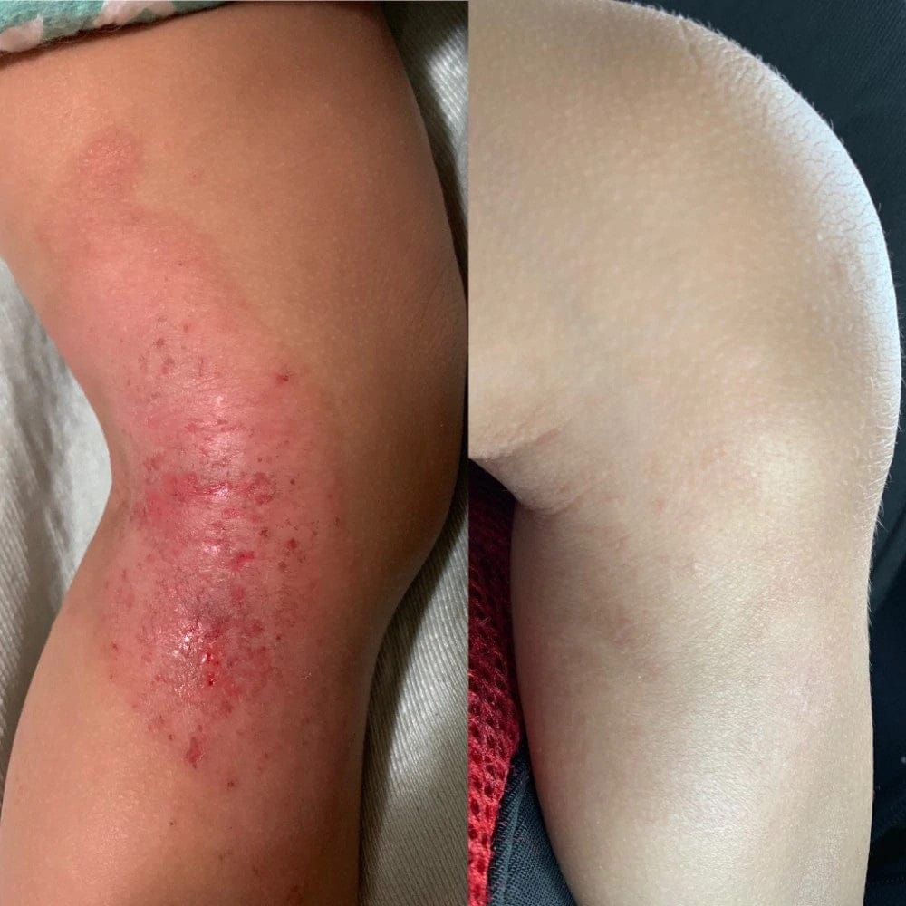 Customer photo review of Smiles & Joys Eczema and Psoriasis Herbal Cream
