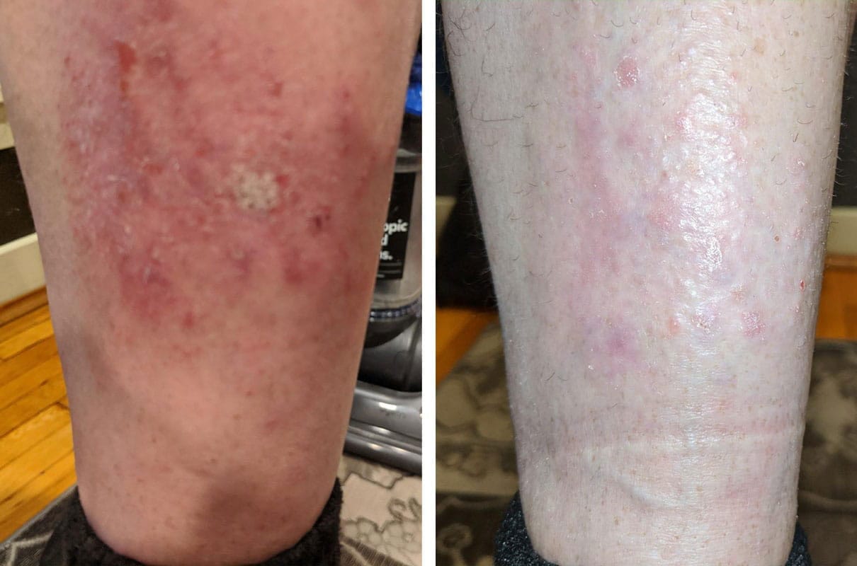 Customer photo review of Smiles & Joys Eczema and Psoriasis Herbal Cream