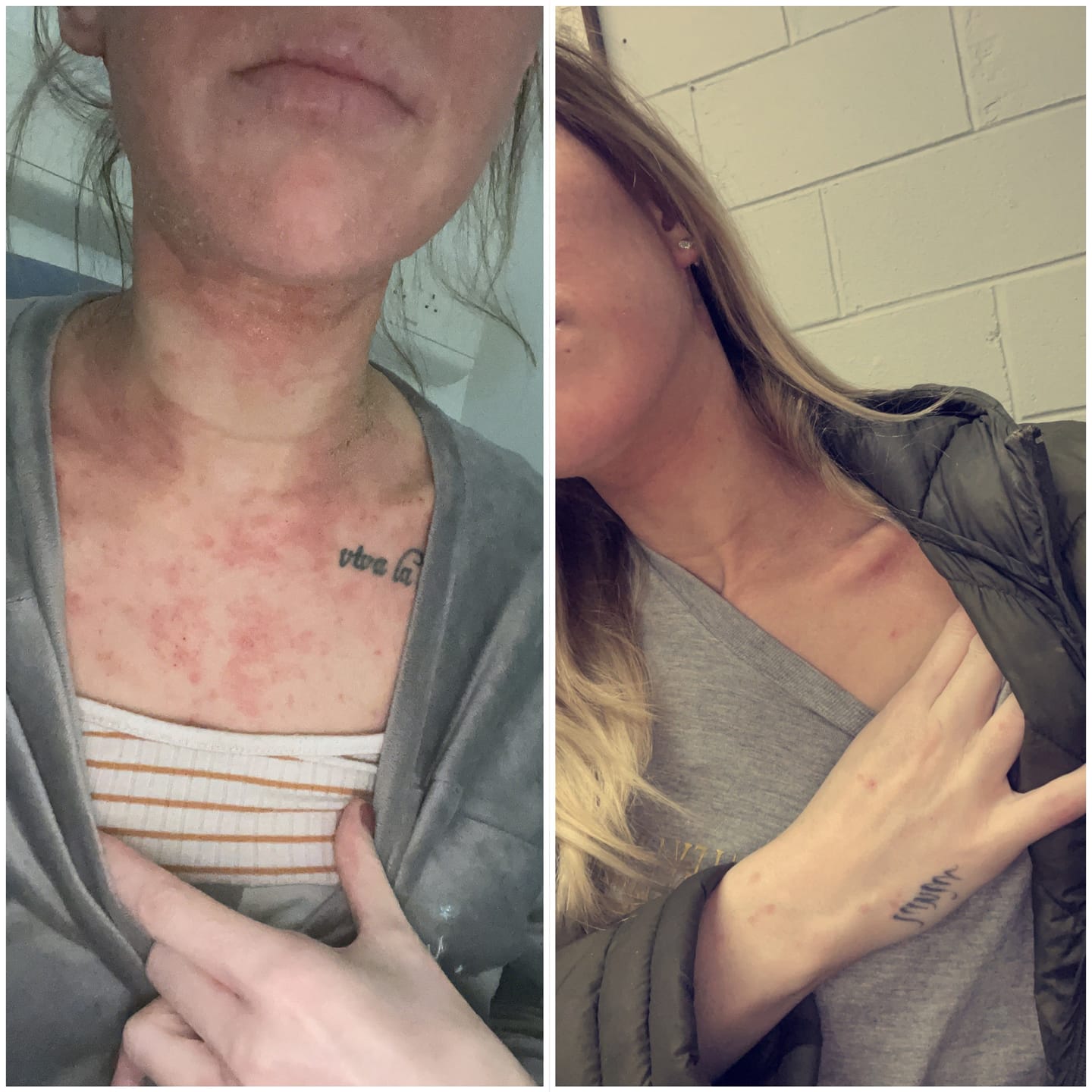 Customer photo review of Smiles & Joys Eczema and Psoriasis Herbal Cream