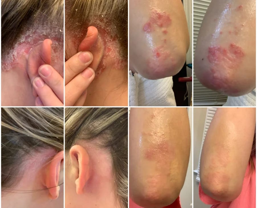 Customer photo review of Smiles & Joys Eczema and Psoriasis Herbal Cream