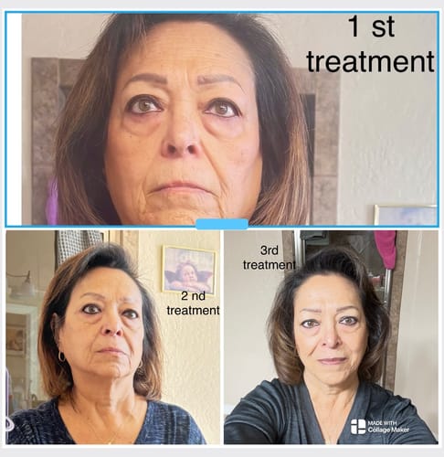 Reviewer's collage showing their face after the 1st, 2nd, and 3rd treatments with the Micro Infusion System.