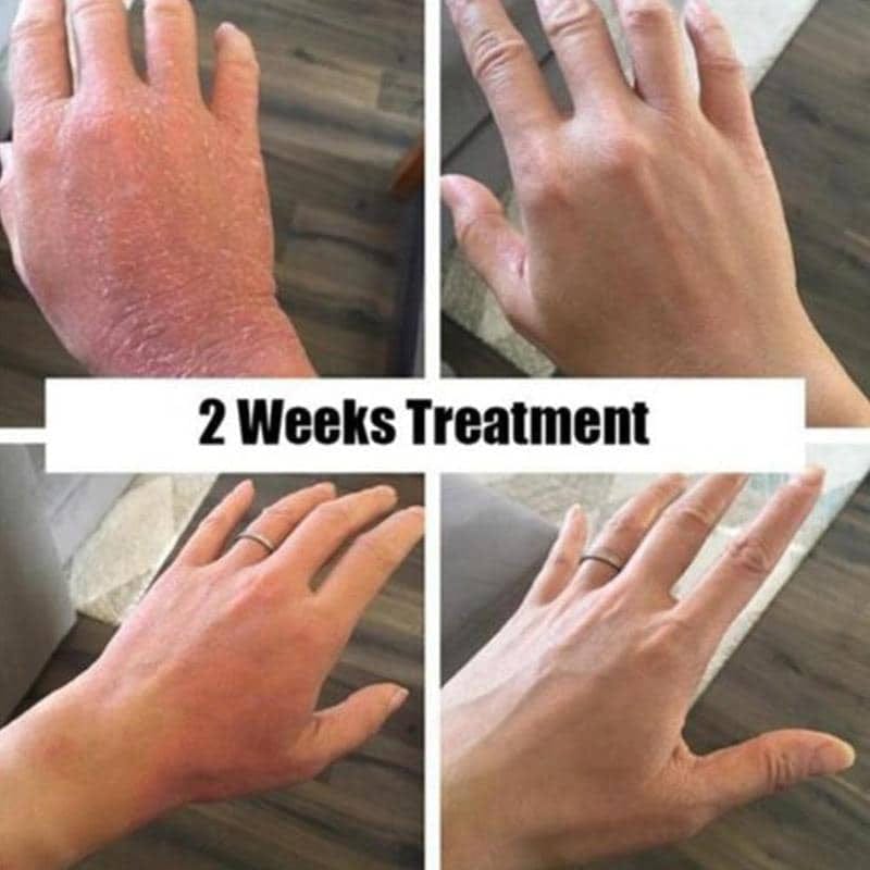 Customer photo review of Smiles & Joys Eczema and Psoriasis Herbal Cream