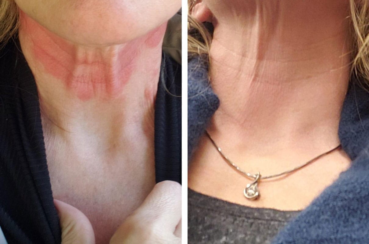 Customer photo review of Smiles & Joys Eczema and Psoriasis Herbal Cream