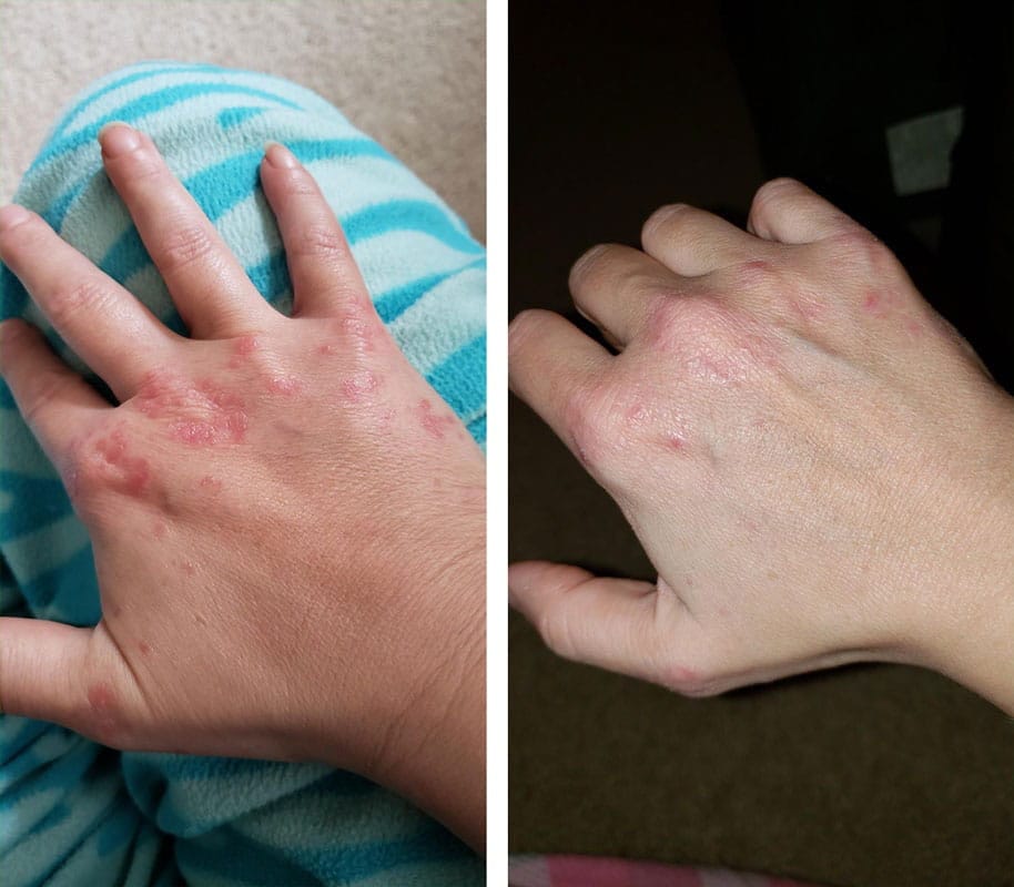 Customer photo review of Smiles & Joys Eczema and Psoriasis Herbal Cream