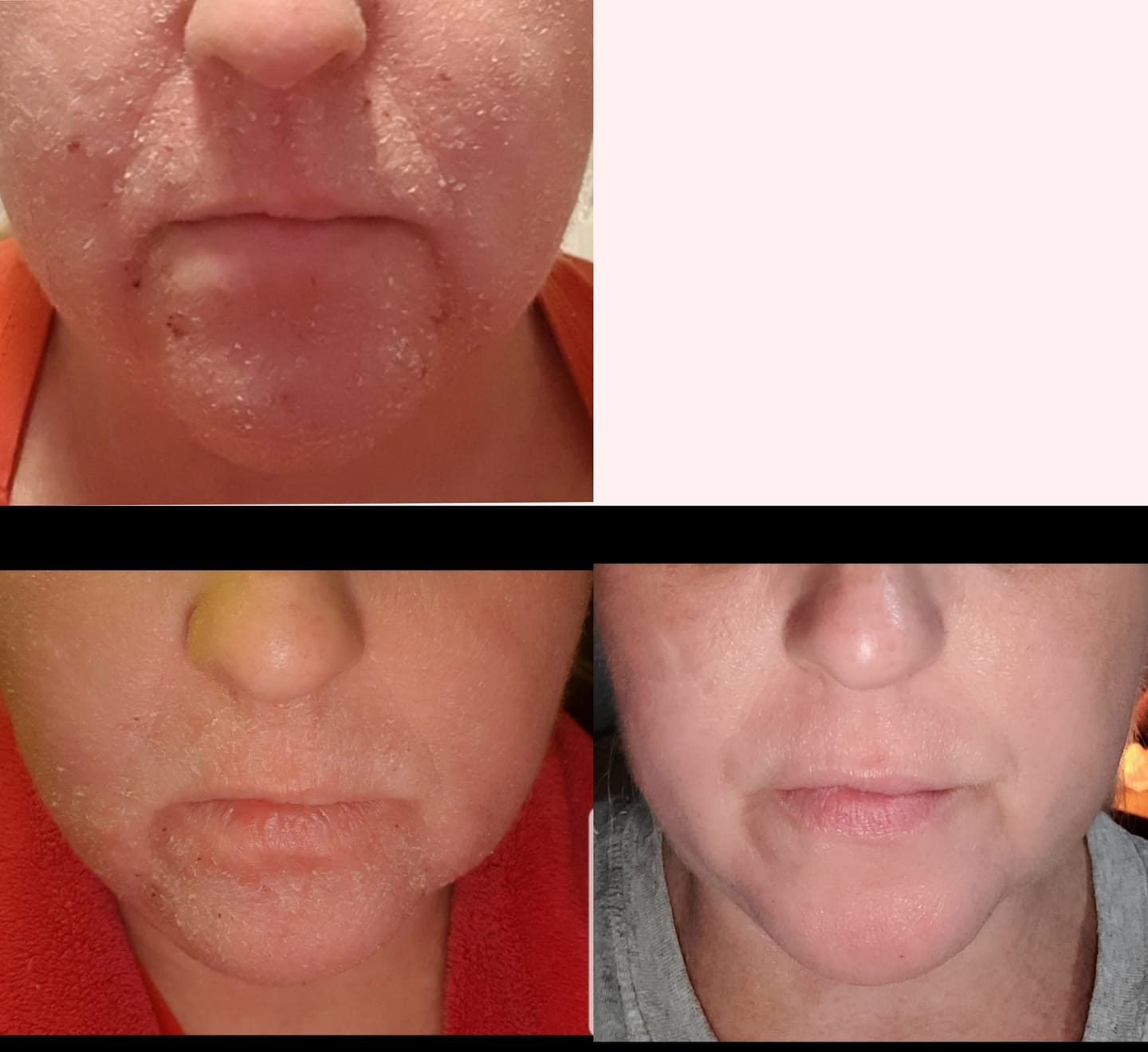 Customer photo review of Smiles & Joys Eczema and Psoriasis Herbal Cream
