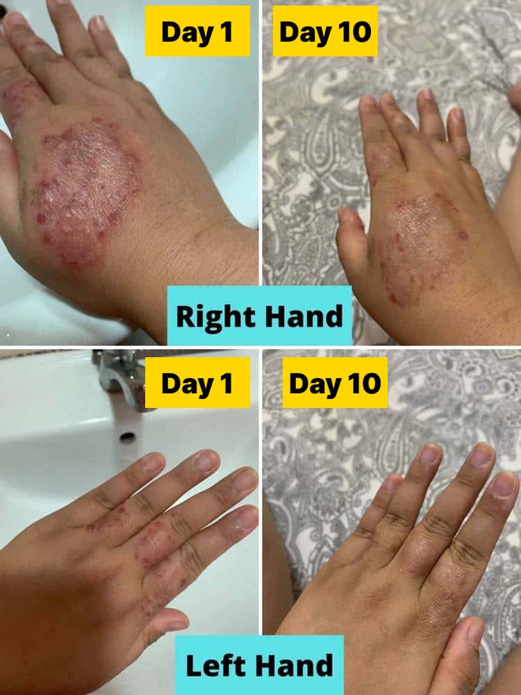 Customer photo review of Smiles & Joys Eczema and Psoriasis Herbal Cream