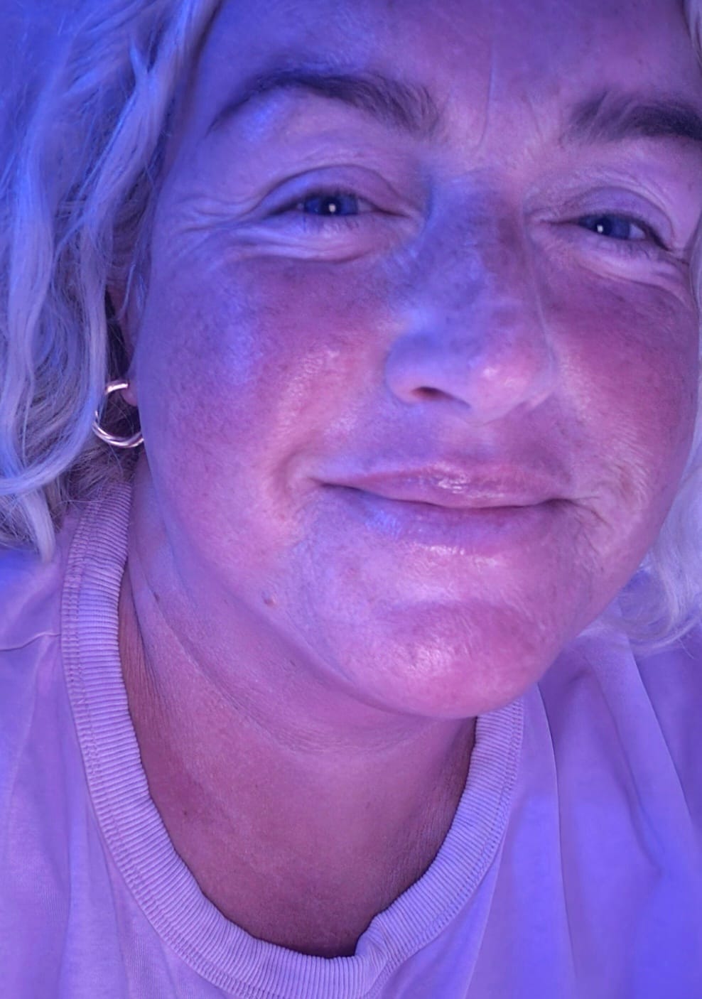 Customer photo review of Glov Intense Rejuvenation Eye Gel Patches