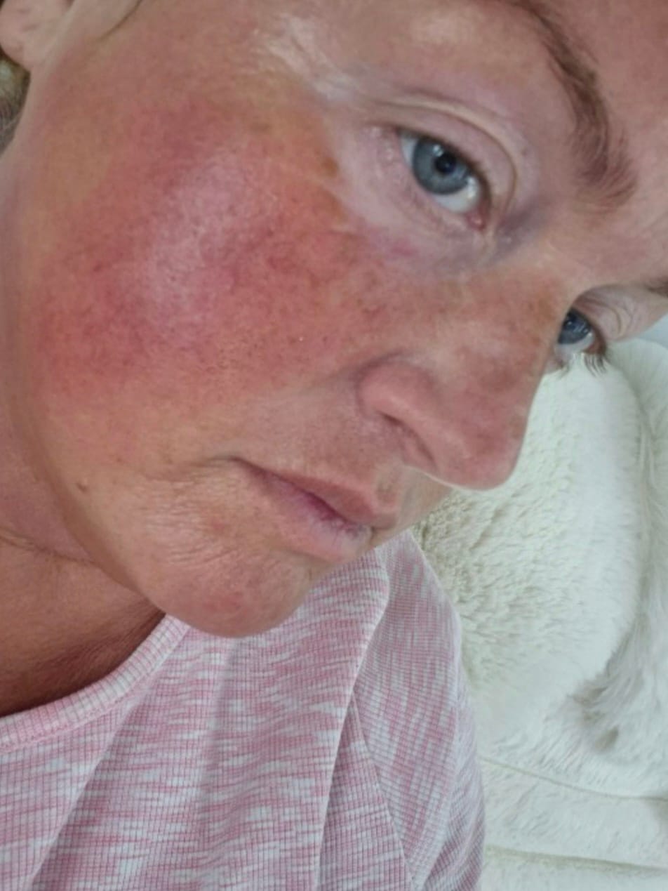 Customer photo review of Glov Micro Infusion System