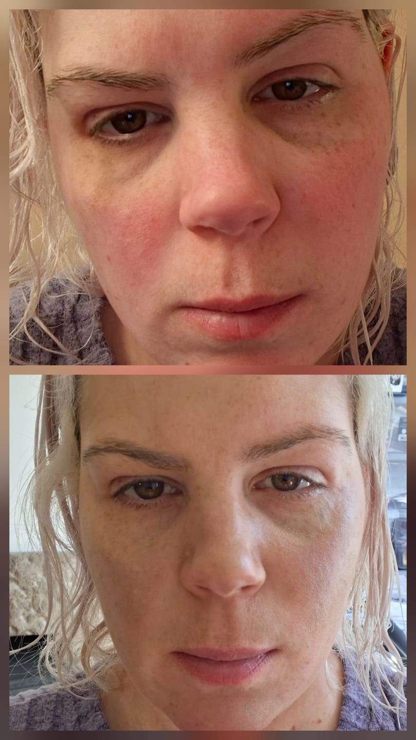 Customer photo review of Rosalique 3 in 1 Anti-Redness Miracle Formula SPF50