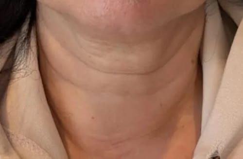 Customer photo review of Herth & Bloom 7-in-1 LED Facial Sculptor