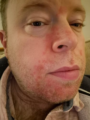 Customer photo review of Seb Natural Soothing Balm