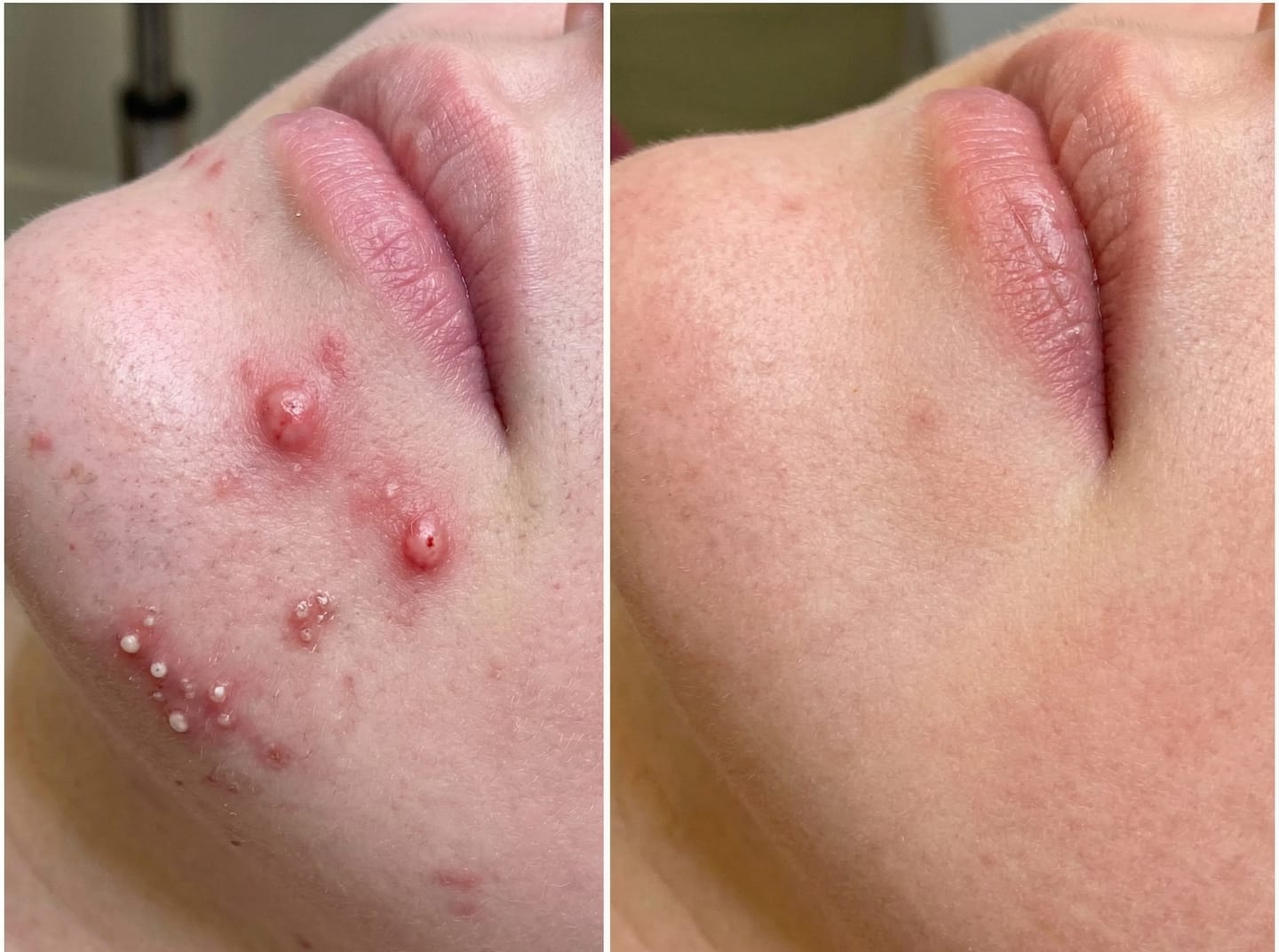 Customer photo review of Complete Gut Repair & Hormonal Balance System for Female Acne