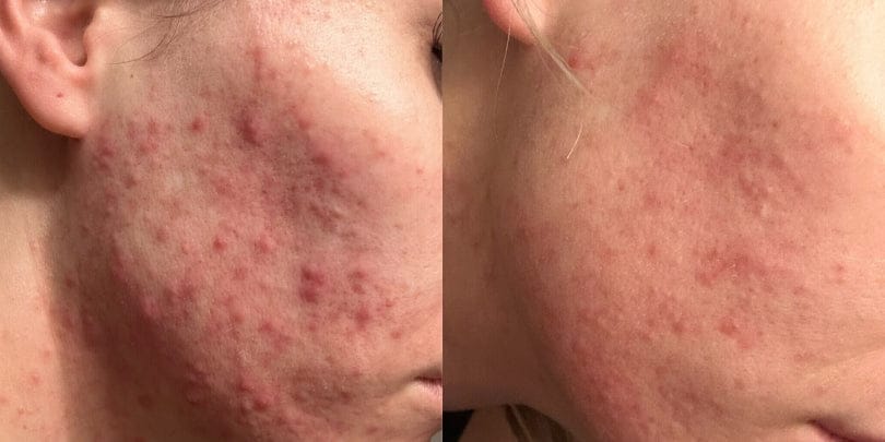 Customer photo review of Complete Gut Repair & Hormonal Balance System for Female Acne