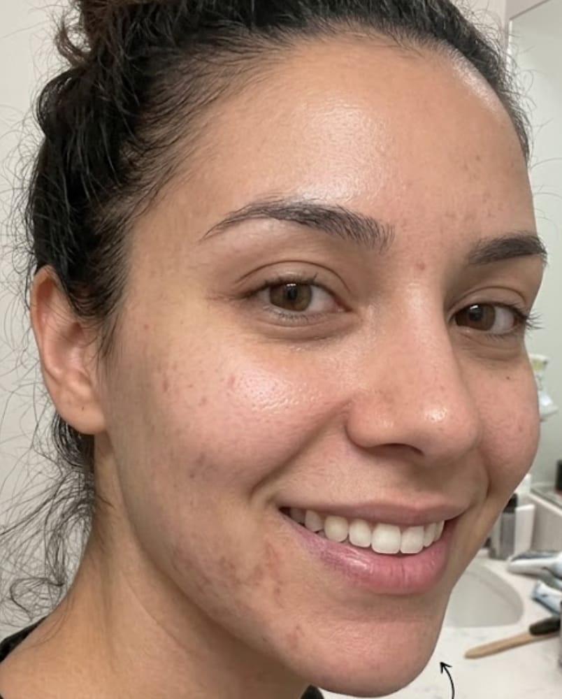Customer photo review of Complete Gut Repair & Hormonal Balance System for Female Acne