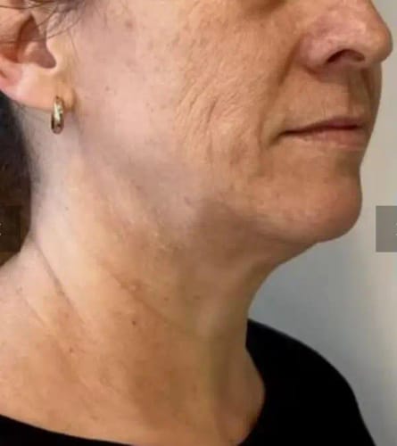 Customer photo review of Herth & Bloom 7-in-1 LED Facial Sculptor