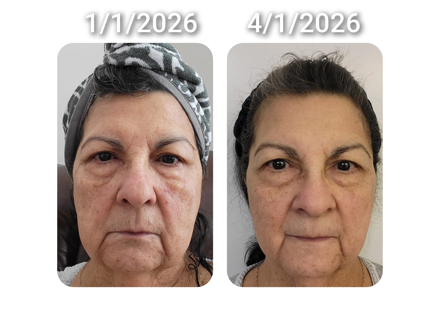 Customer photo review of 6 Month Supply - Deep Collagen Cream