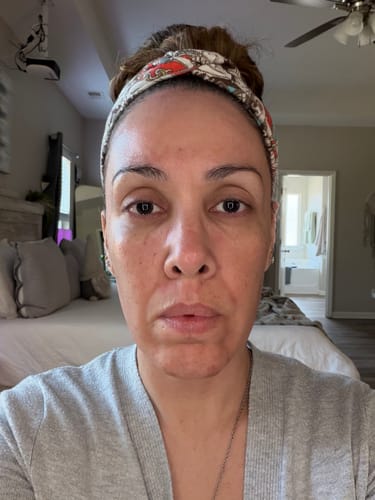 Reviewer's close-up selfie showing skin results from the Seranova Micro Infusion System.