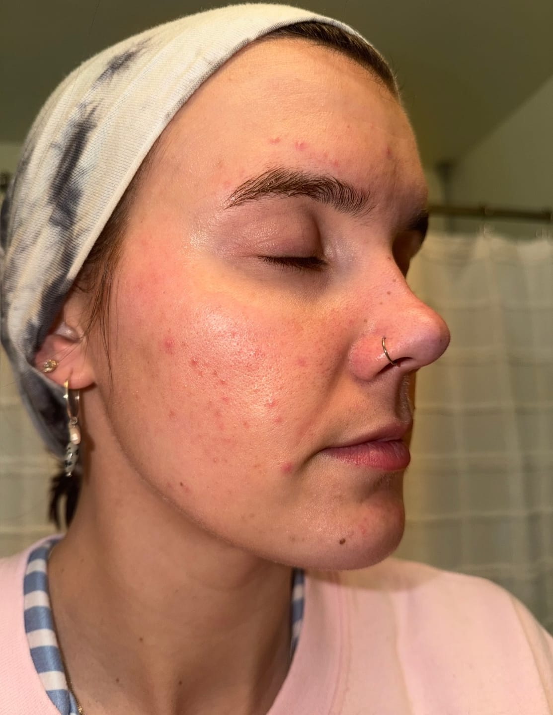 Customer photo review of Pimple Stopper Night Balm