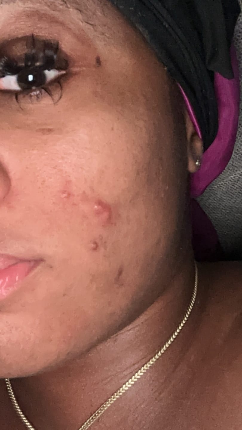 Customer photo review of Discoloration Brightening Corrector ( 3 BARS )