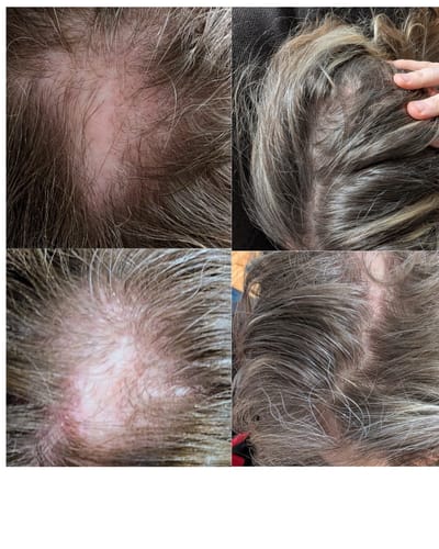 Customer's before-and-after photos showing hair growth after using the Rosemary and Keratin Shampoo.