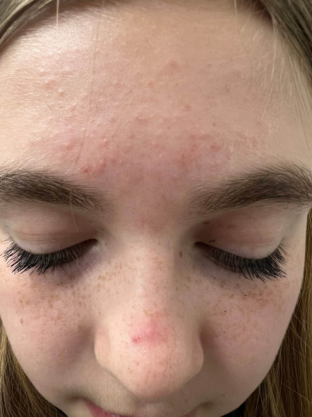 Customer photo review of Pimple Stopper Night Balm