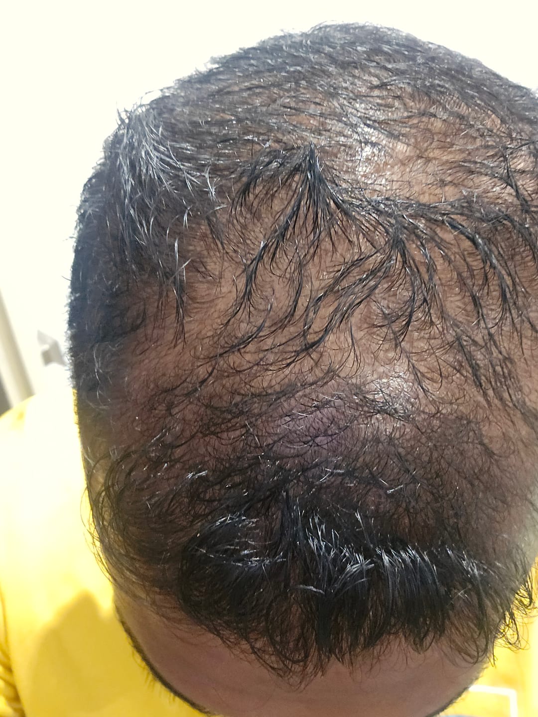 Customer photo review of Minoxidil DOUBLE ACTION Solution - MEN ONLY, 3x60ml pack