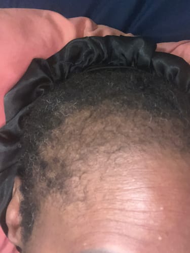 Reviewer's hairline showing new, short hair growth after using Rennora Hair Growth Serum.