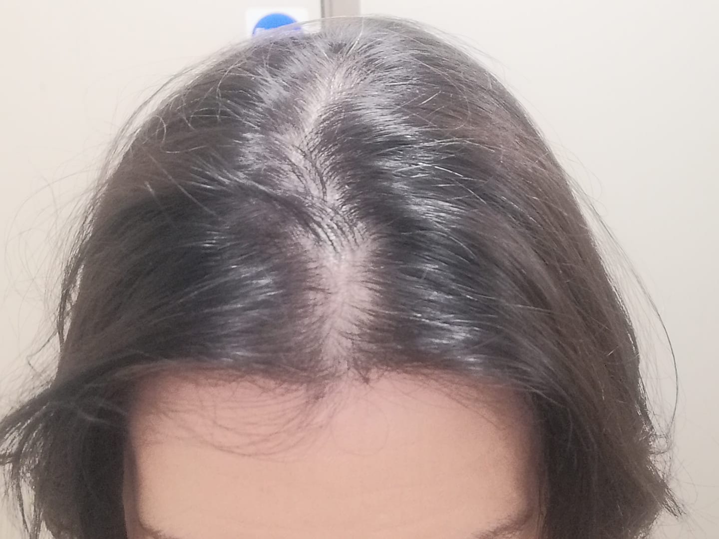 Customer photo review of VITAFOAM ™ Hair Growth Formula