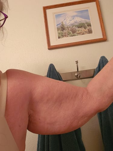 Customer's close-up of their upper arm, showing the area for the Silix™ 3D Compression Sleeves.