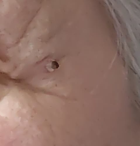 Customer photo review of Bőrkinövés Eltávolító Készlet