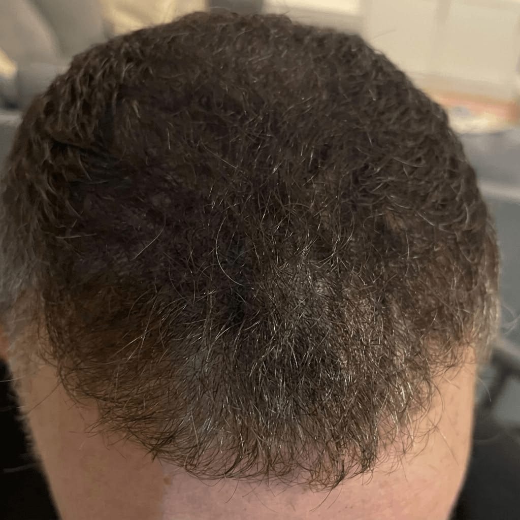 Customer photo review of Filler Capillare in polvere