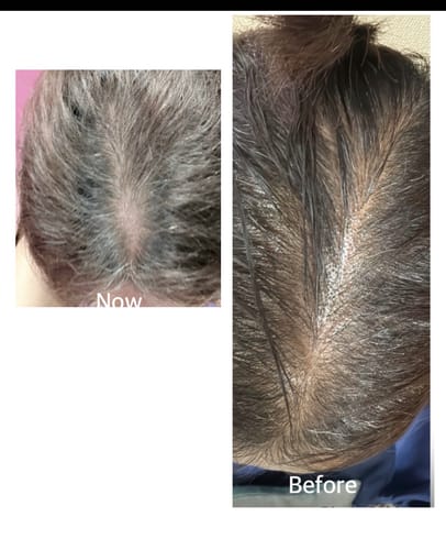 Customer photo review of Advance Hair Growth Serum 2.0 (30ml)