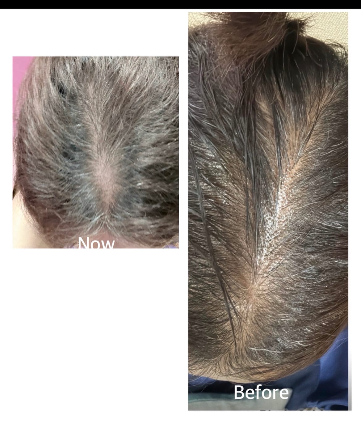 Customer photo review of Advance Hair Growth Serum 2.0 (30ml)