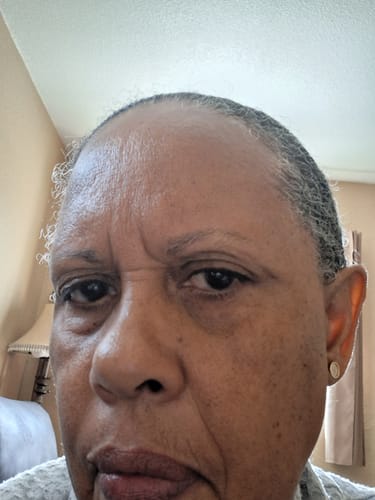 Reviewer's close-up showing new hair growth along the hairline after using Rennora Hair Growth Serum.