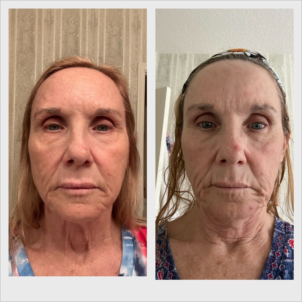 Customer photo review of INIA FLARE Microcurrent Facial Device