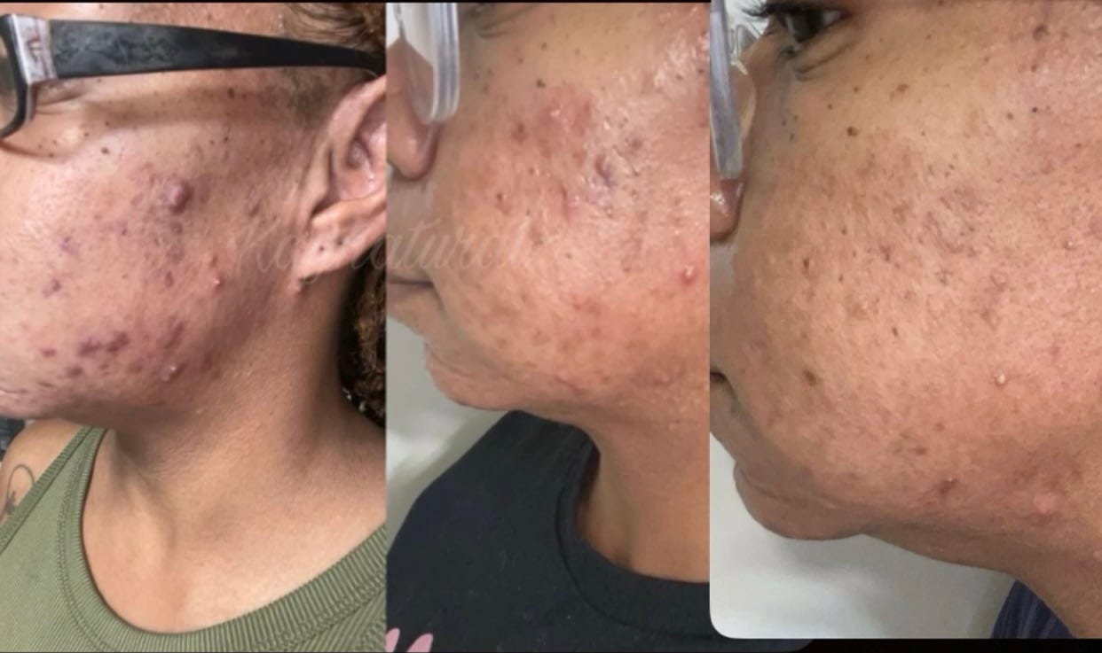 Customer photo review of Duo Skincare Bundle