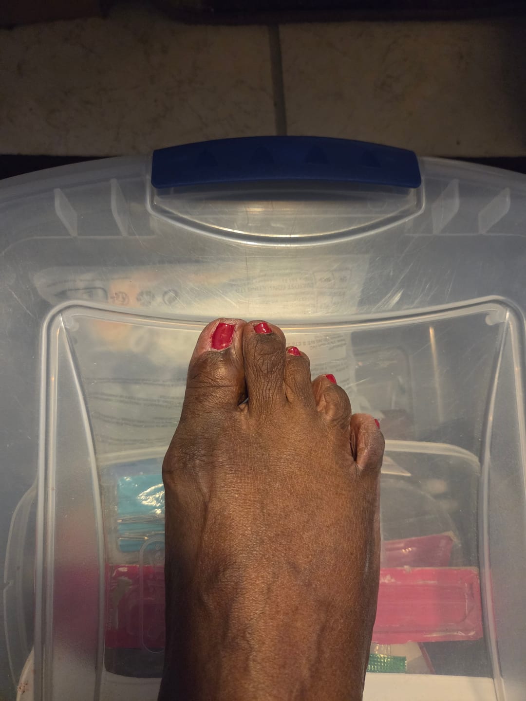 Customer photo review of Treatmedy™ Bunion Fix