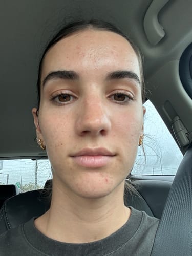Customer photo review of Advanced Acne Program™