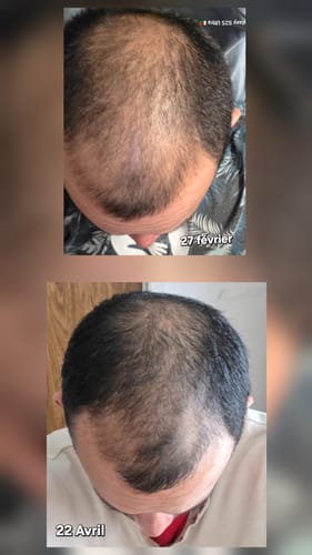 Reviewer's before-and-after image of hair becoming visibly thicker after using the rosemary and keratin shampoo.