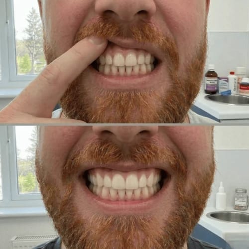 Customer photo review of Exy Red Light Toothbrush