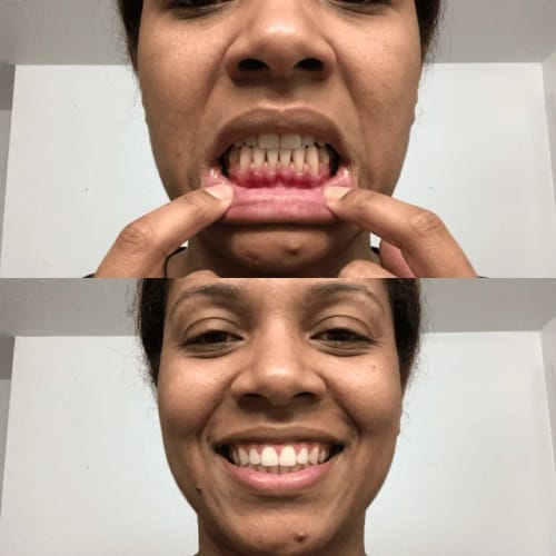 Customer photo review of Exy Red Light Toothbrush