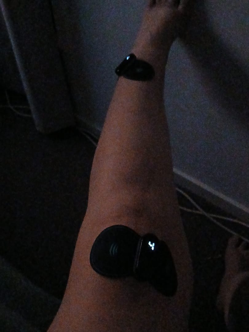 Customer photo review of Vibit TENS - Electrical Nerve Stimulation Therapy