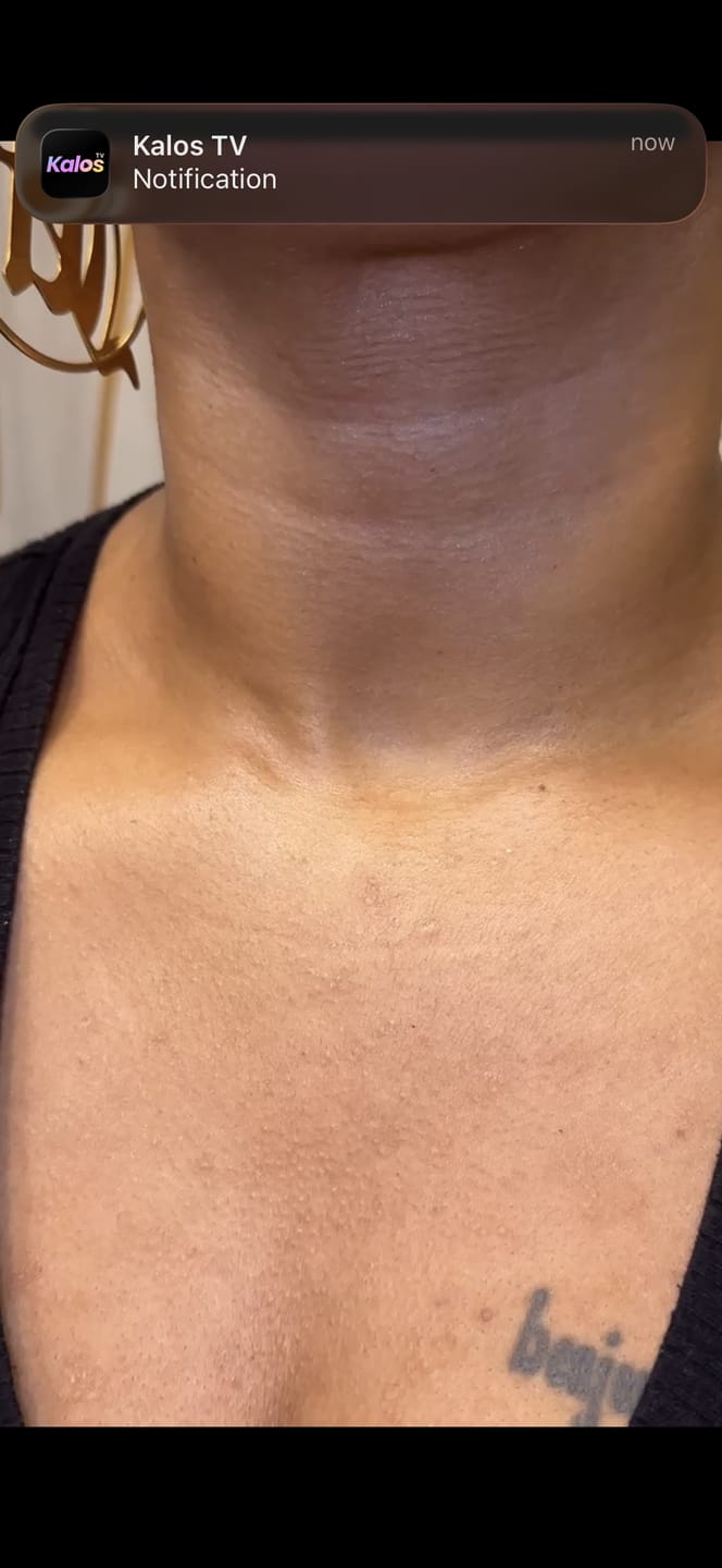 Customer photo review of PDRN Volume fill-it Booster crème 2.5 tube