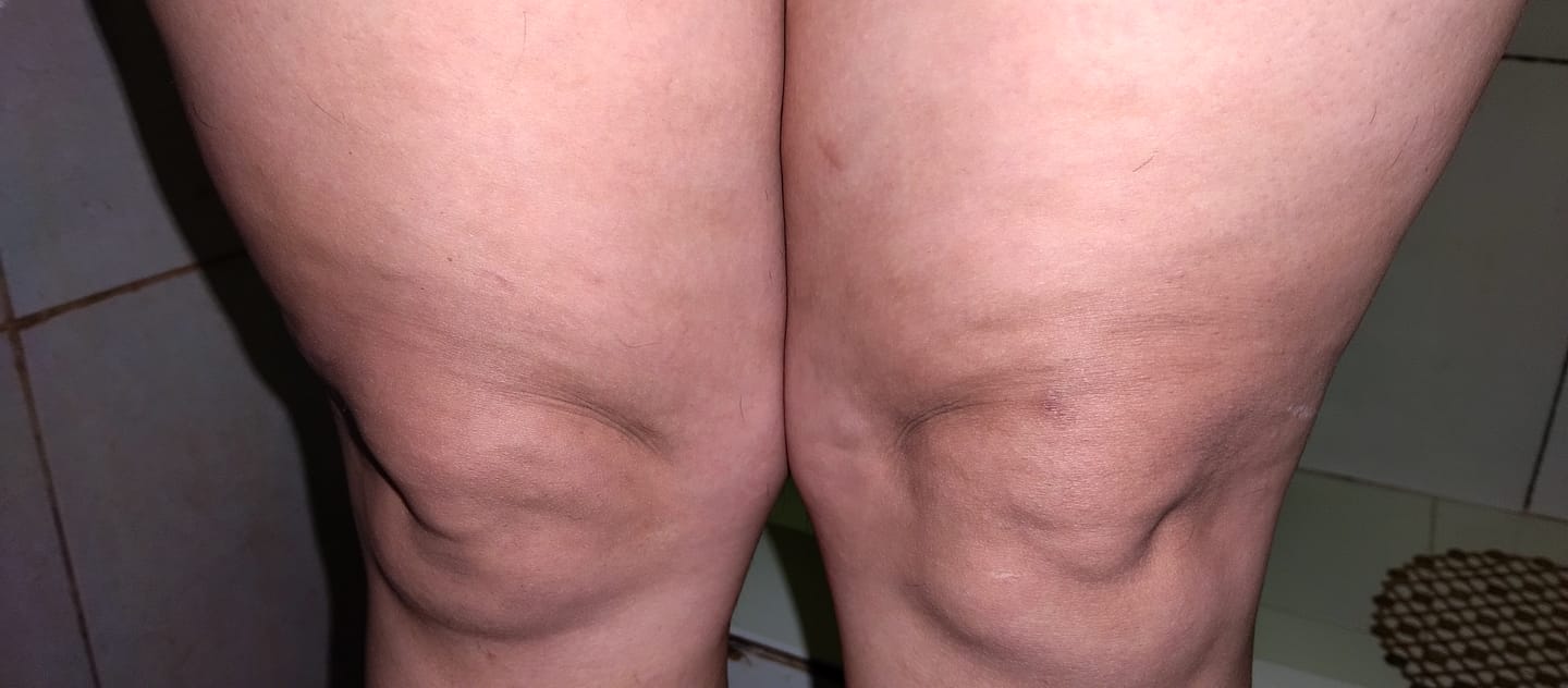 Customer photo review of Crema para Celulitis  Emily • 200ml