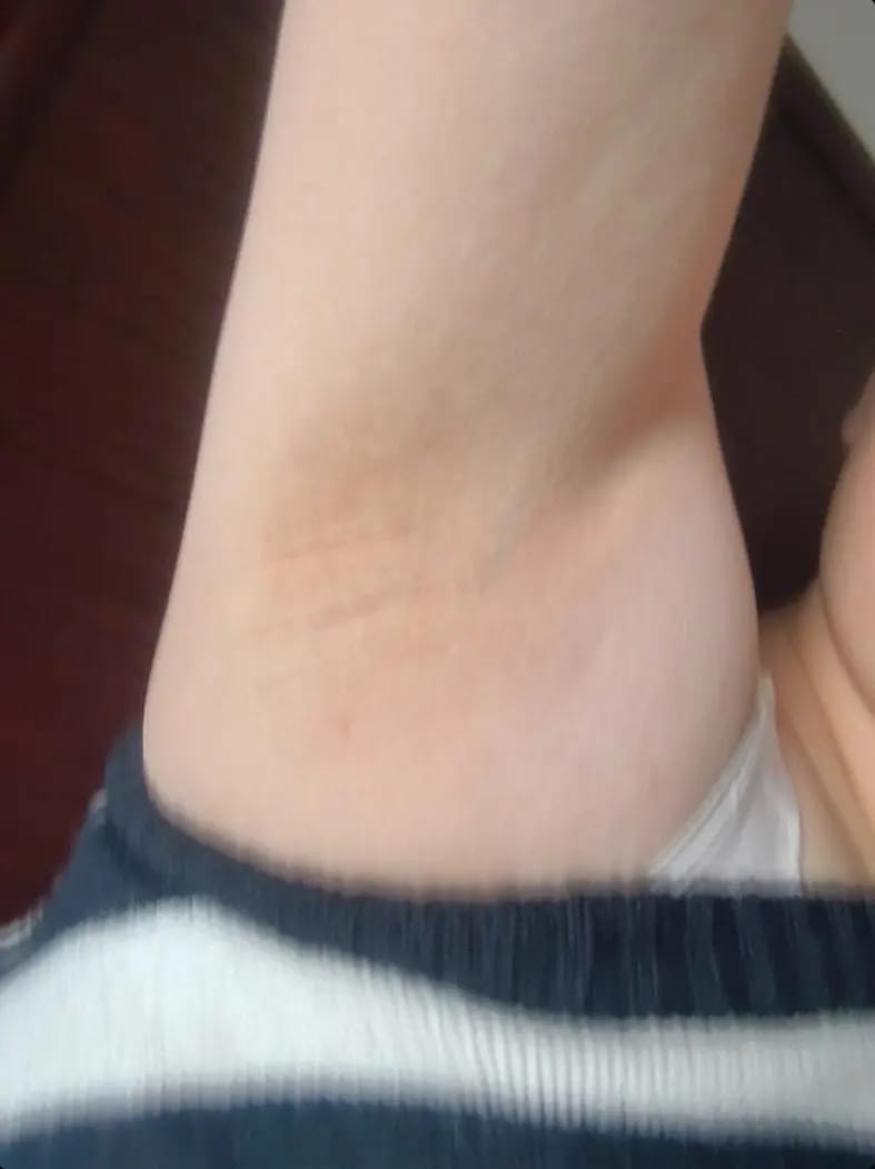 Customer photo review of Multi Laser Platform - Hair Removal Diode + Nd YAG