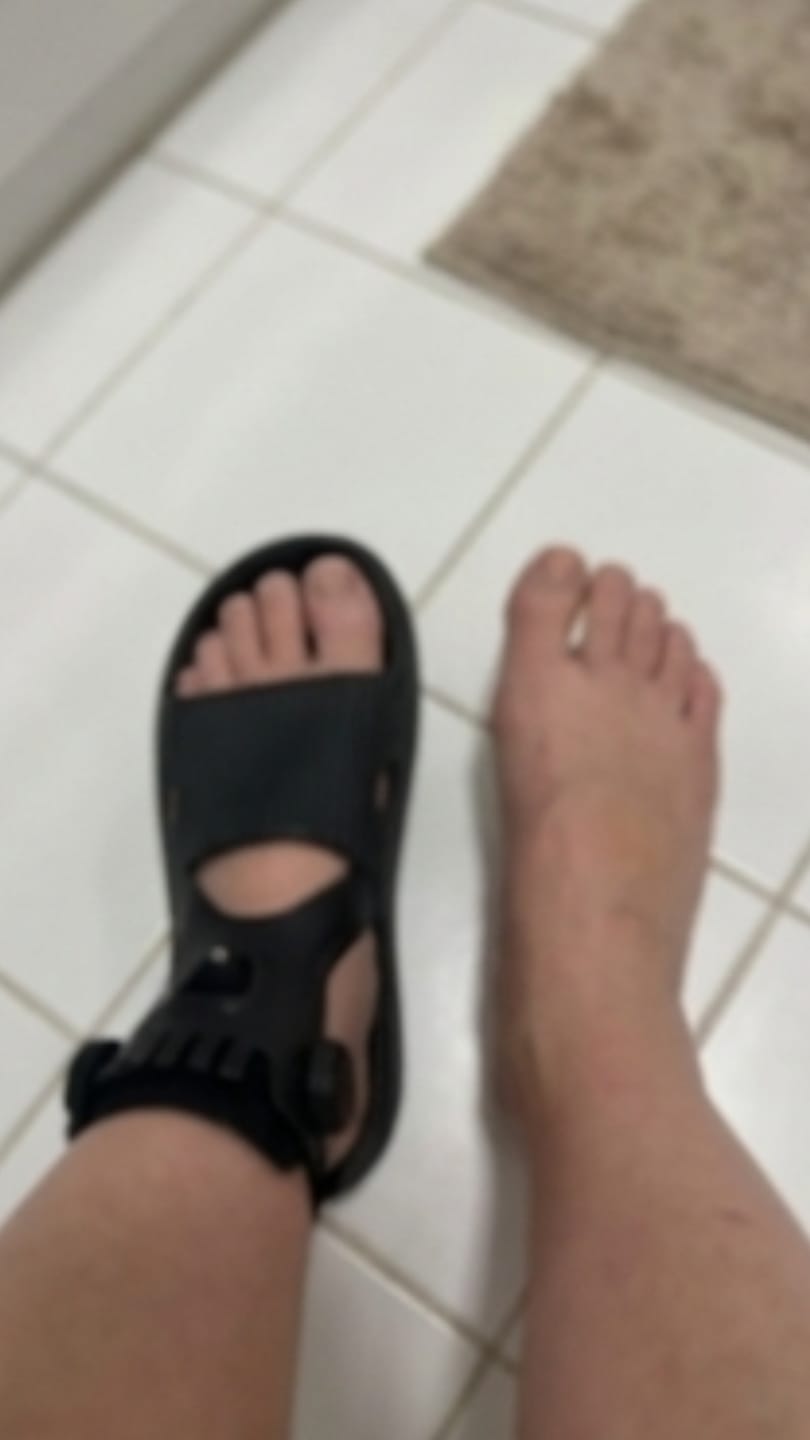 Customer photo review of Orthevo | Fußheberorthese