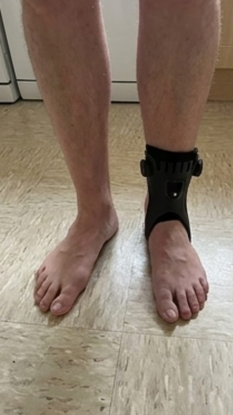 Customer photo review of Orthevo | Fußheberorthese