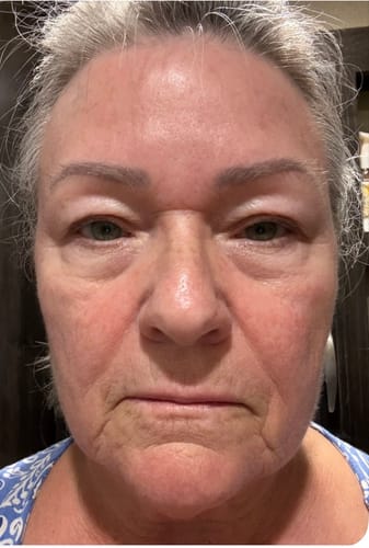 A close-up of the reviewer's face, a progress photo while using The Micro Infusion System.