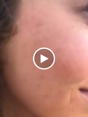 Customer video review of Tindved og nesle til ansikt