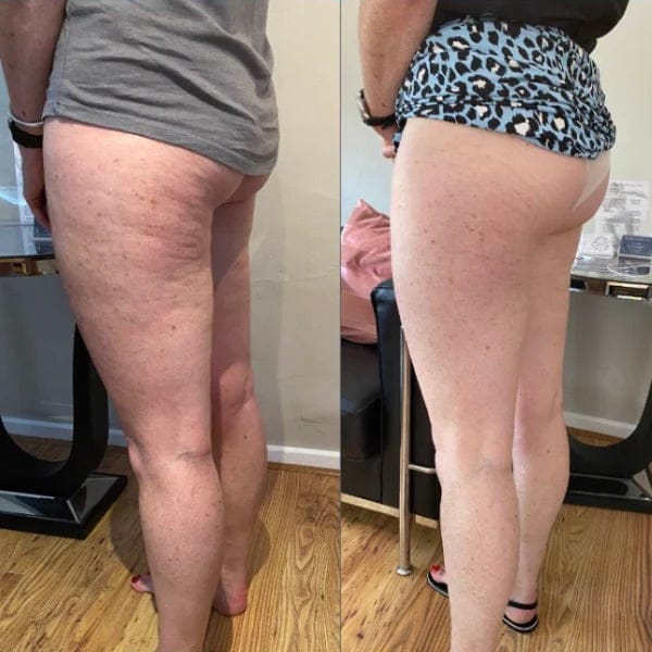 Customer photo review of Cellura™- Feszesítő Szépségroller